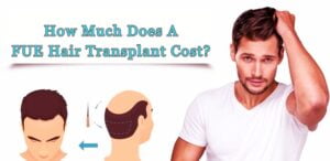 FUE Hair Transplant Cost